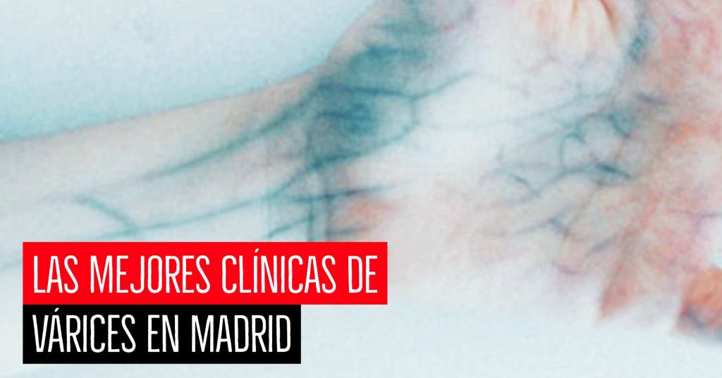 Mejores clínicas de várices en Madrid