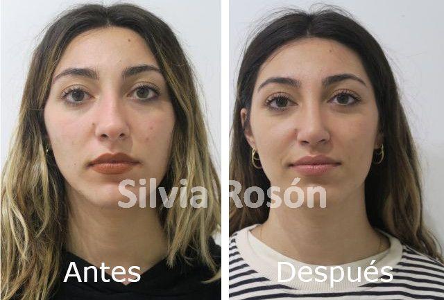 Dra Silvia Rosón cirugía de bolas de bichat
